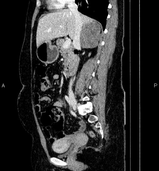 Adrenal cortical carcinoma (Radiopaedia 84882-100379 Sagittal C+ portal venous phase 39).jpg