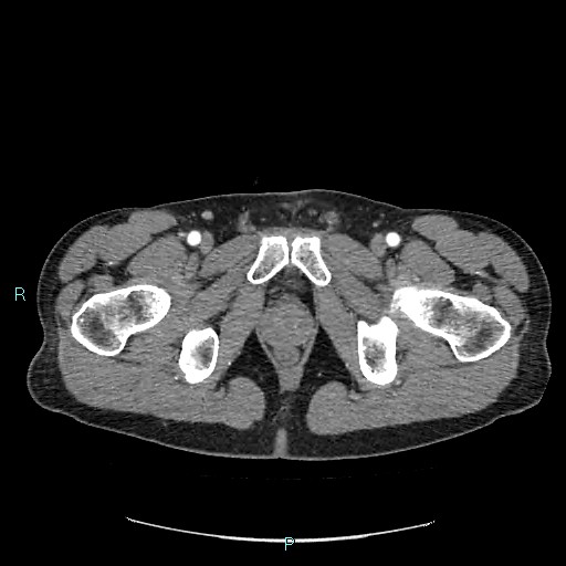 Adrenal cystic lymphangioma (Radiopaedia 83161-97534 Axial C+ arterial phase 101).jpg