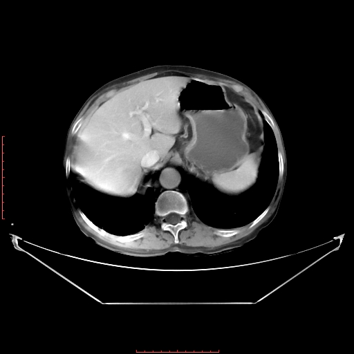 Adrenal hemangioma (Radiopaedia 68923-78668 Axial C+ portal venous phase 20).jpg