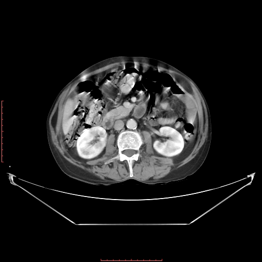 Adrenal hemangioma (Radiopaedia 68923-78668 Axial C+ portal venous phase 35).jpg
