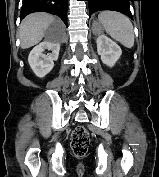 Adrenal lymphoma (Radiopaedia 73730-84529 Coronal C+ portal venous phase 61).jpg