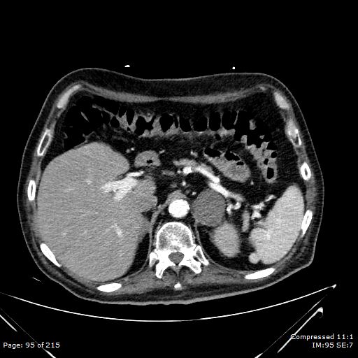 Adrenal metastasis (Radiopaedia 78425-91079 Axial C+ arterial phase 25).jpg