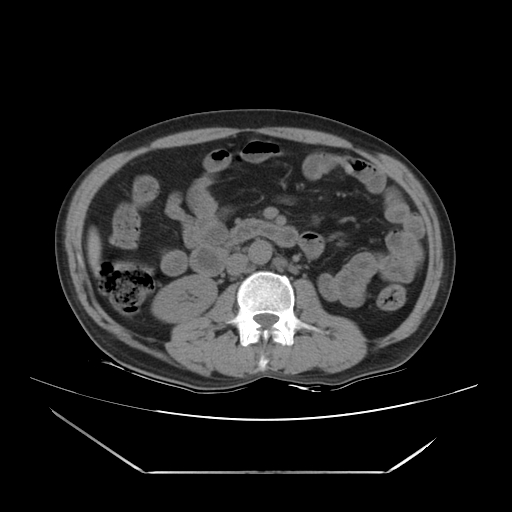 File:Adrenal myelolipoma (Radiopaedia 41843-44834 Axial non-contrast 38).jpg