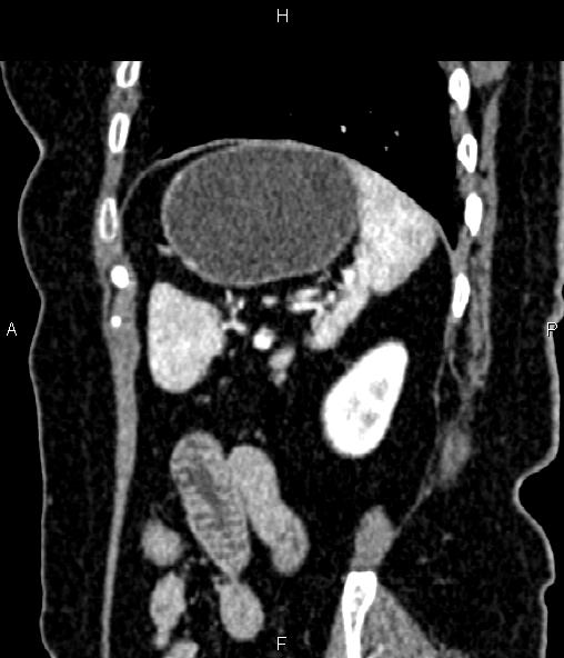 Adrenal myelolipoma (Radiopaedia 82742-96986 Sagittal renal cortical phase 85).jpg