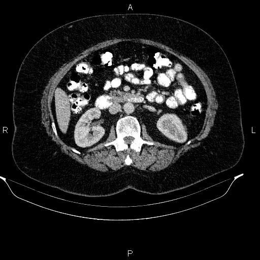 Adrenal myelolipoma (Radiopaedia 84319-99617 Axial renal cortical phase 52).jpg