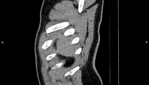 Adrenal myelolipoma (Radiopaedia 84321-99619 Sagittal non-contrast 105).jpg