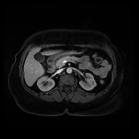 Adrenal myelolipoma - MRI (Radiopaedia 83249-97646 T1 fat sat arterial phase 41).jpg