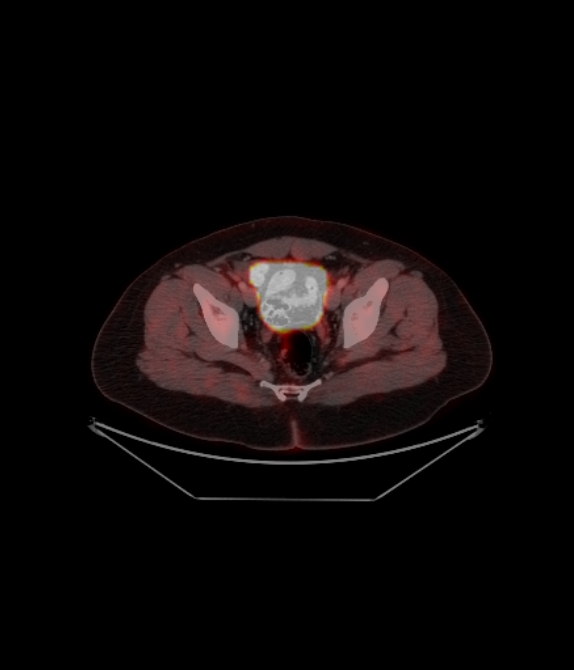 Adrenocortical carcinoma (Radiopaedia 80134-93440 ِAxial 239).jpg