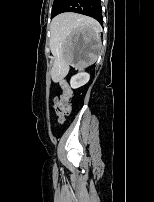 Adrenocortical carcinoma (Radiopaedia 87281-103569 Sagittal C+ portal venous phase 50).jpg