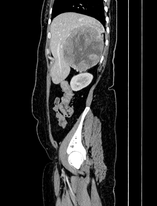 Adrenocortical carcinoma (Radiopaedia 87281-103569 Sagittal C+ portal venous phase 53).jpg