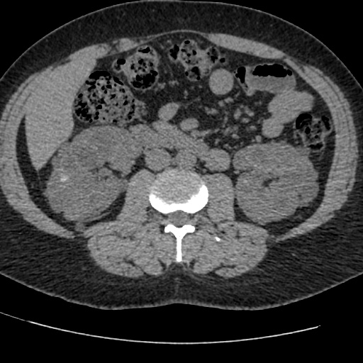 Adult polycystic kidney disease (Radiopaedia 59075-66368 Axial non-contrast 39).jpg