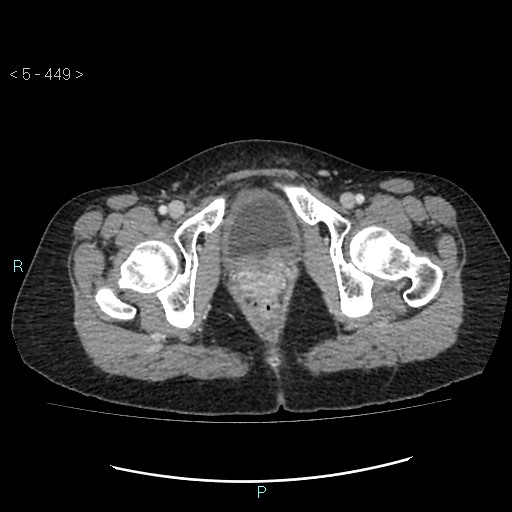Adult transient intestinal intussusception (Radiopaedia 34853-36310 Axial C+ portal venous phase 120).jpg