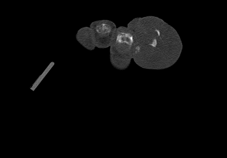 Advanced osteomyelitis due to open metatarsal fracture (Radiopaedia 83891-99095 Axial bone window 52).jpg
