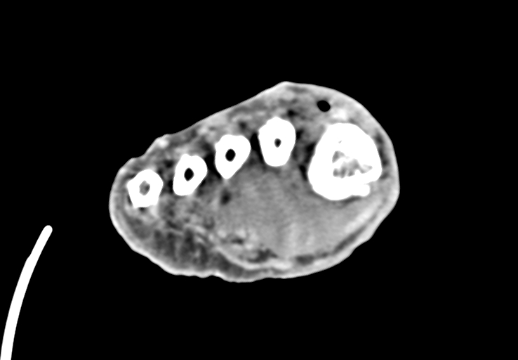 Advanced osteomyelitis due to open metatarsal fracture (Radiopaedia 83891-99095 Axial non-contrast 34).jpg