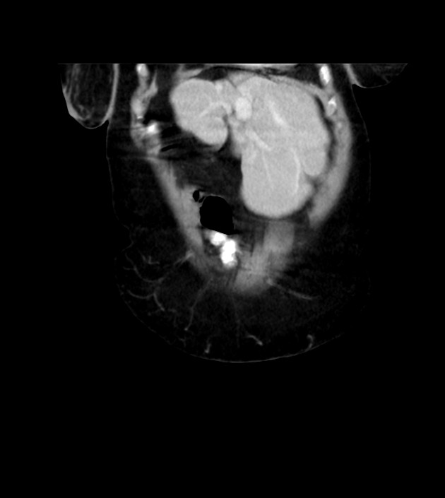 Agenesis of the right hepatic lobe (Radiopaedia 78273-90871 D 61).jpg
