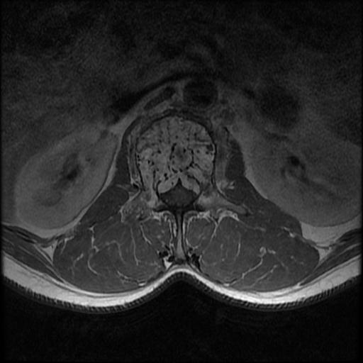 File:Aggressive vertebral hemangioma with pathological fracture (Radiopaedia 69528-79411 Axial T1 C+ 12).jpg