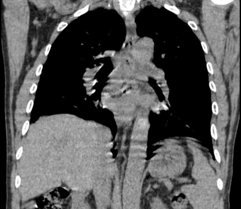 Airway foreign body in adult (Radiopaedia 85907-101779 Coronal liver window 161).jpg