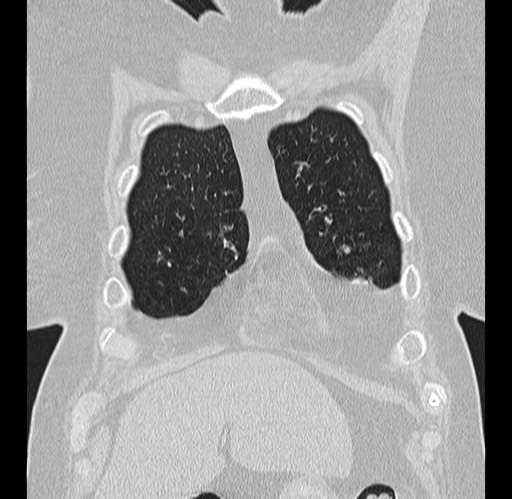 Alpha-1-antitrypsin deficiency (Radiopaedia 72058-82557 Coronal lung window 2).jpg