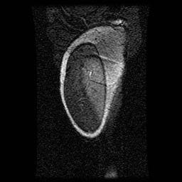 Alveolar soft part sarcoma (Radiopaedia 64501-73678 D 131).jpg