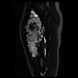 Alveolar soft part sarcoma (Radiopaedia 64501-73678 D 76).jpg