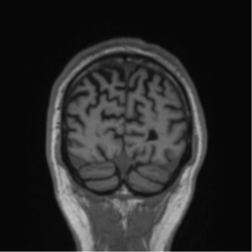 File:Alzheimer's disease- with Gerstmann syndrome and dressing apraxia (Radiopaedia 54882-61150 Coronal T1 14).png