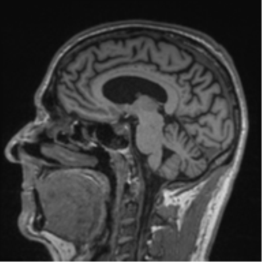 Alzheimer's disease- with Gerstmann syndrome and dressing apraxia (Radiopaedia 54882-61150 Sagittal T1 32).png