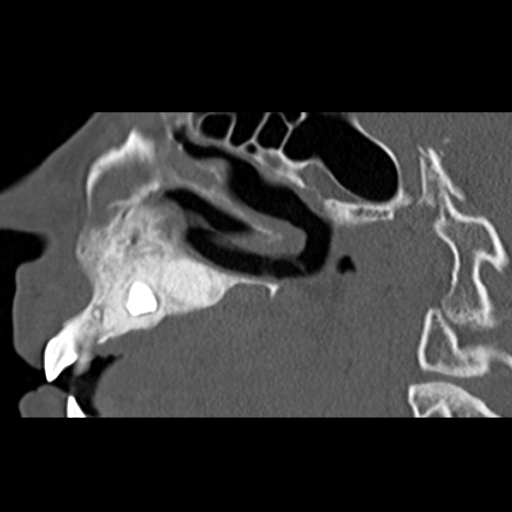 File:Ameloblastic fibro-odontoma (Radiopaedia 18843-18780 bone window 5).jpg