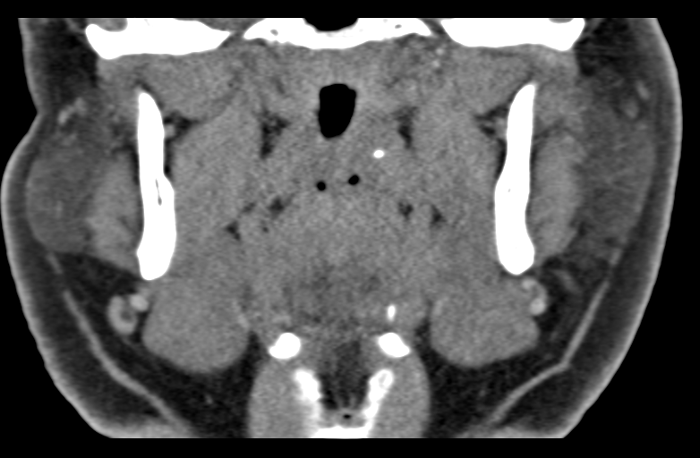 Ameloblastoma (Radiopaedia 33677-34806 Coronal non-contrast 36).png