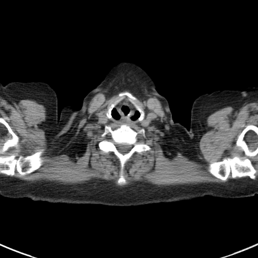 File:Amiodarone-induced pulmonary fibrosis (Radiopaedia 82355-96460 Axial non-contrast 1).jpg