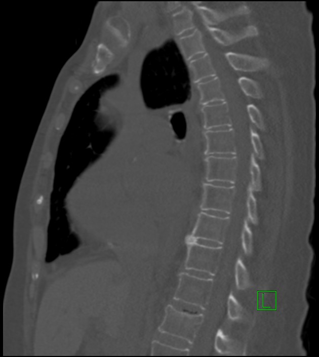 Amiodarone deposition in the liver (Radiopaedia 77587-89780 Sagittal bone window 54).jpg