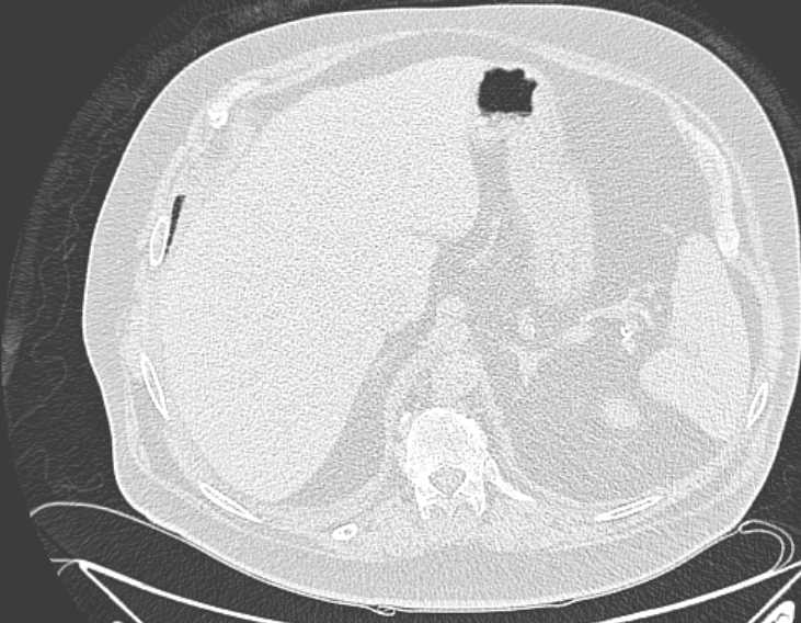 Amiodarone lung (Radiopaedia 62514-70769 Axial lung window 83).jpg