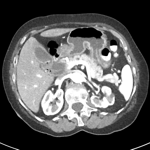 File:Ampullary adenocarcinoma (Radiopaedia 34013-35237 B 29).png