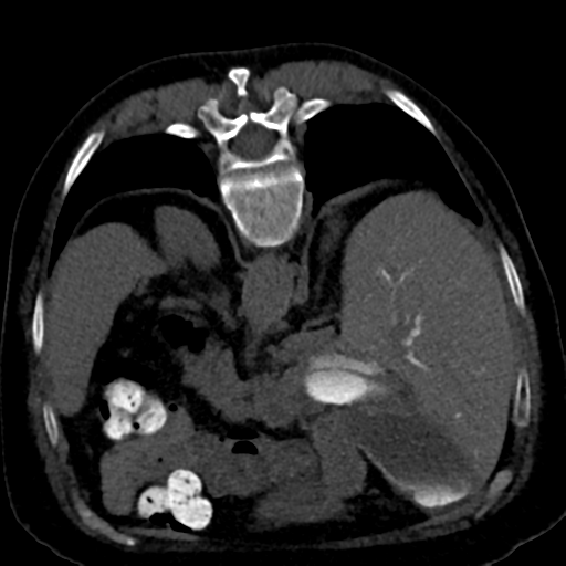Ampullary adenocarcinoma (Radiopaedia 34013-35241 C 33).png