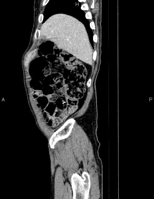 Ampullary adenocarcinoma (Radiopaedia 86093-102032 D 10).jpg