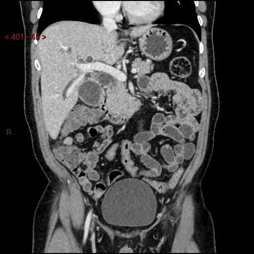 Ampullary carcinoma (Radiopaedia 56396-63056 E 44).jpg
