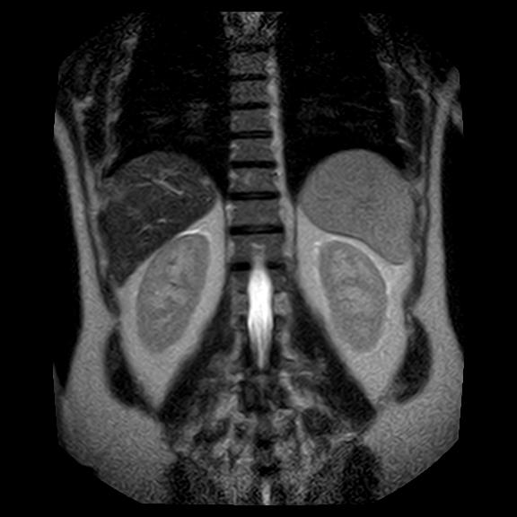 File:Ampullary tumor (Radiopaedia 27294-27479 Coronal T2 21).jpg