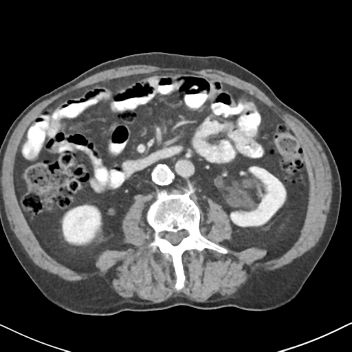 File:Amyand hernia (Radiopaedia 39300-41547 A 33).png