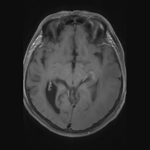 File:Amyloid angiopathy with inflammation (Radiopaedia 30360-31002 Axial T1 C+ fat sat 14).jpg