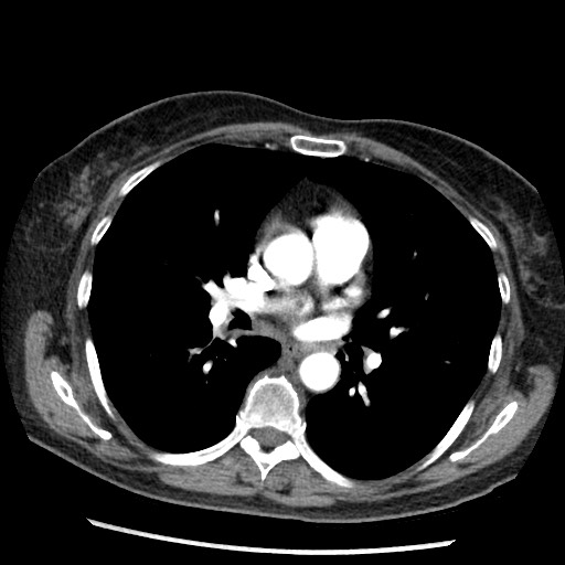 File:Amyloidosis - bronchial and diffuse nodular pulmonary involvement (Radiopaedia 60156-67745 A 26).jpg
