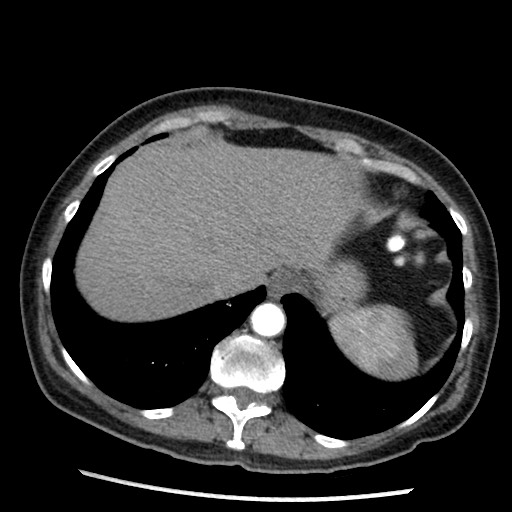 Amyloidosis - bronchial and diffuse nodular pulmonary involvement (Radiopaedia 60156-67745 A 46).jpg