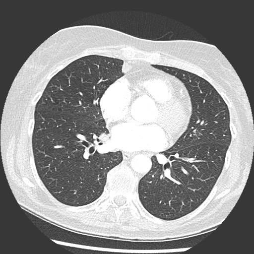 Amyloidosis - bronchial and diffuse nodular pulmonary involvement (Radiopaedia 60156-67745 Axial lung window 49).jpg