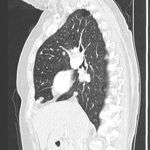 Amyloidosis - bronchial and diffuse nodular pulmonary involvement (Radiopaedia 60156-67745 Sagittal lung window 36).jpg