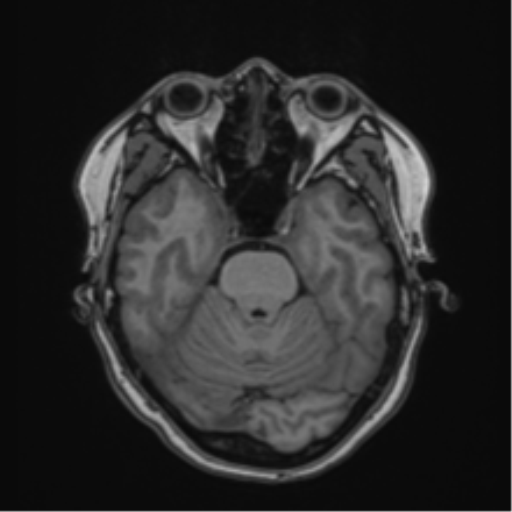 Anaplastic astroblastoma (Radiopaedia 55666-62194 Axial T1 24).png