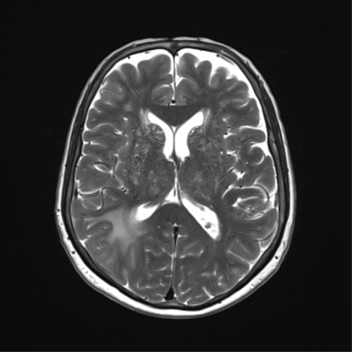File:Anaplastic astrocytoma (Radiopaedia 86943-103160 Axial T2 22).png