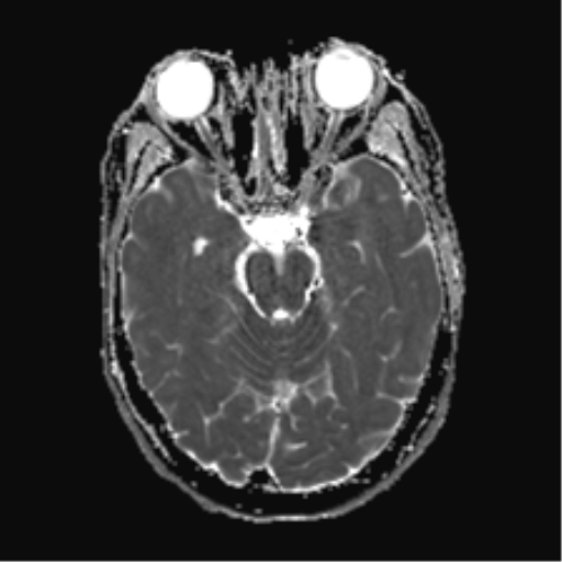 File:Anaplastic astrocytoma IDH mutant (Radiopaedia 50046-55341 Axial ADC 10).png