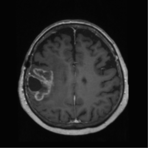 File:Anaplastic astrocytoma IDH wild-type (pseudoprogression) (Radiopaedia 42209-45278 Axial T1 C+ 105).png