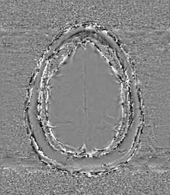 Anaplastic oligodendroglioma (Radiopaedia 83500-98599 Axial SWI - phase 73).png