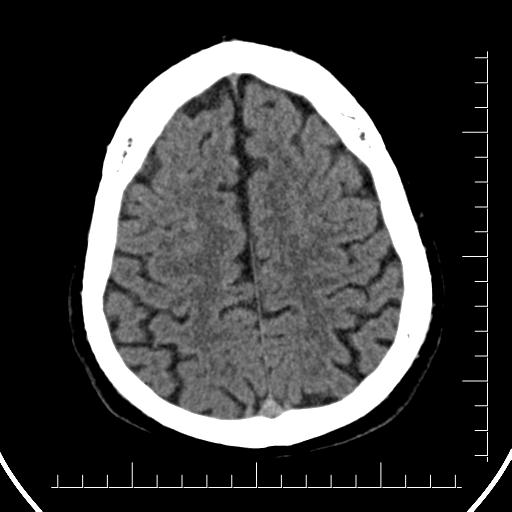 Aneurysm of posterior communicating artery (Radiopaedia 20188-20162 Axial non-contrast 38).jpg
