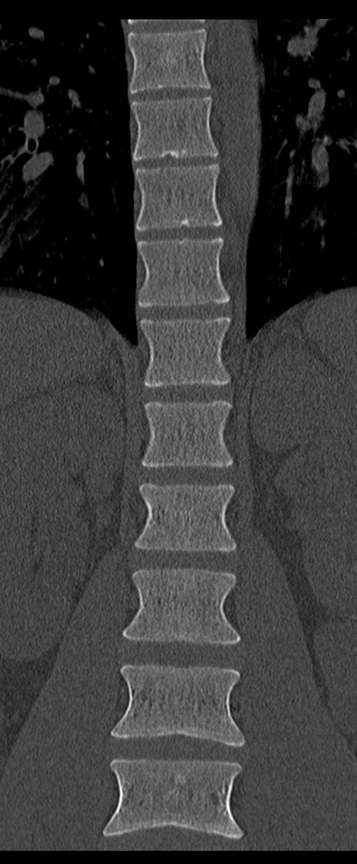 Aneurysmal bone cyst T11 (Radiopaedia 29294-29721 Coronal bone window 22).jpg