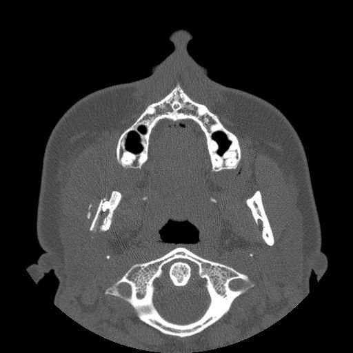 Aneurysmal bone cyst of the mandible (Radiopaedia 43280-46823 Axial bone window 94).jpg